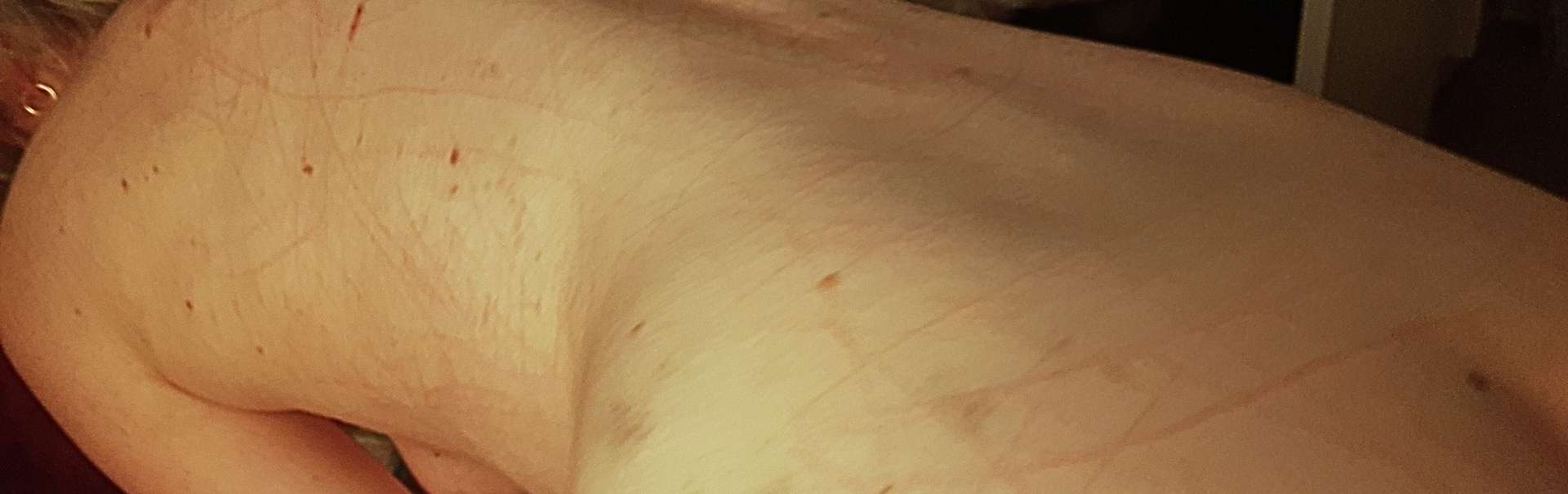 Scratch marks from kink fetish bdsm claw rings