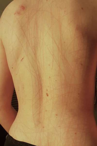 Scratch marks from kink fetish bdsm claw rings